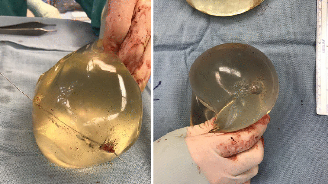 Breast Implant stops Bullet