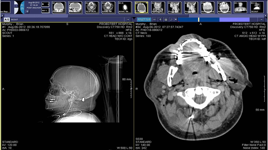 CT scan of Lt. Murphy's skull after the incident.