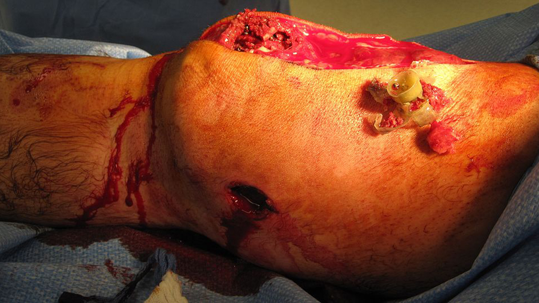 gunshot wounds shotgun knee