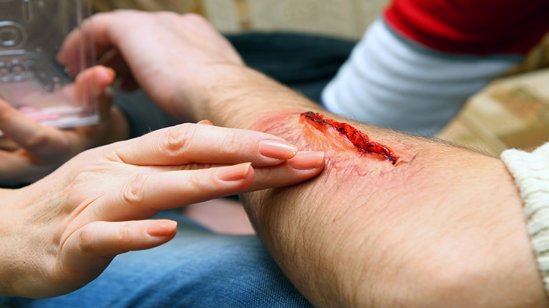 Deep wounds can be closed and treated properly without stitches.